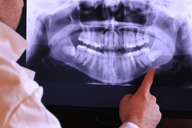 Best Knocked-Out Tooth (Avulsed Tooth) Treatment in Dayton, OH